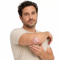 Psoriasis