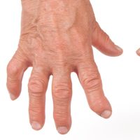 Rheumatoid arthritis