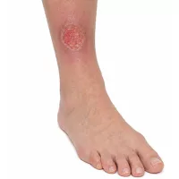 Lábszárfekély