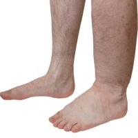 Ér és nyirokbetegség