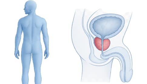 Pénisz rehabilitáció prosztata műtét után – vákuumos tréning protokoll