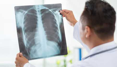 Covid-19 fertőzés utáni rehabilitáció