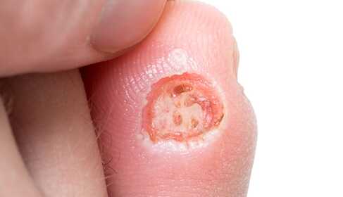 Cukorbeteg láb – mit tehetsz a megelőzése érdekében?