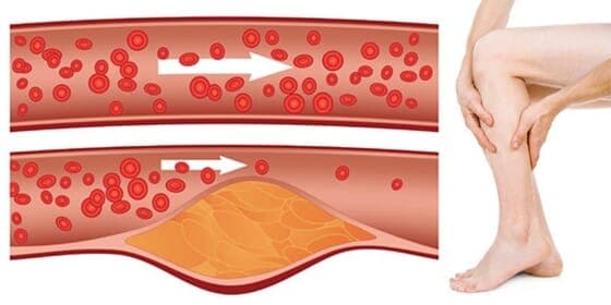 Érelmeszesedés és érszűkület okai és kezelése