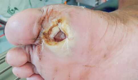 Lábszárfekély kezelése lágylézer készülékkel