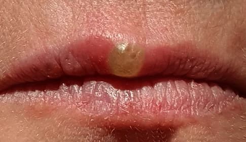 Lágylézer kezelés herpesz ellen – Gyorsabb gyógyulás otthon