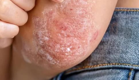 Lágylézer és pikkelysömör – Mit érdemes tudni?