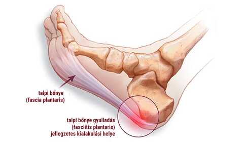 Talpi bőnye gyulladás, azaz plantar fasciitis