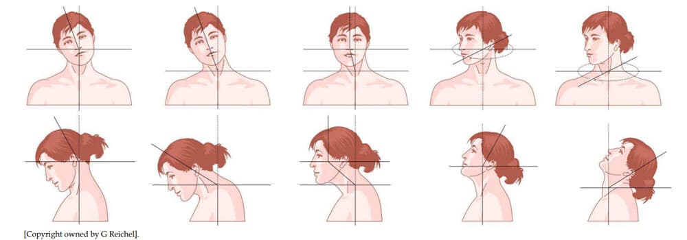 torticollis richtingen van scheve nek