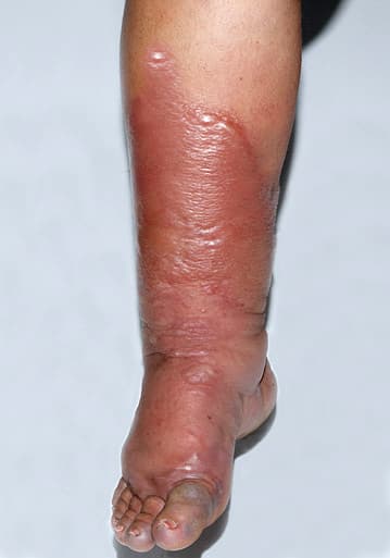 verschijnsel van wondroos