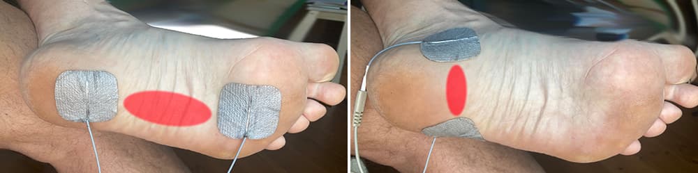 talpi bőnye gyulladás, fasciitis plantaris, sarkantyú gyulladás kezelése mikroárammal