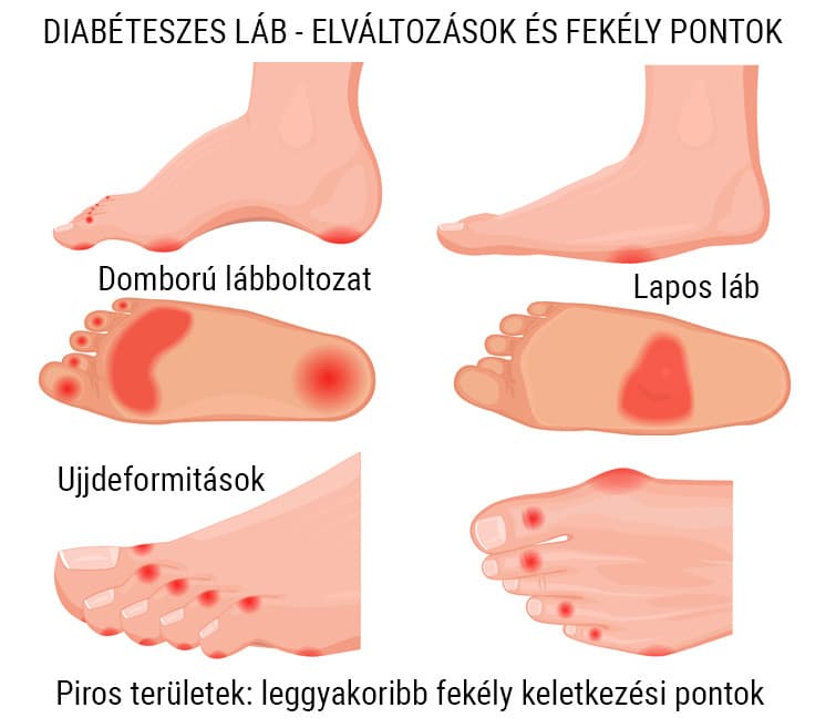 Diabeteszes-lab-elvaltozasok-es-fekely-pontok.jpg