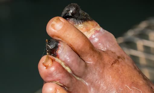 Diabeteszes-lab-szovetelhalas-gangrena.jpg