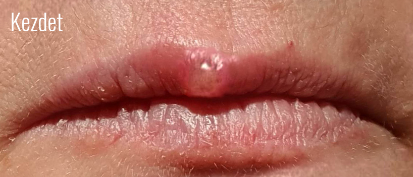 Herpes1.jpg