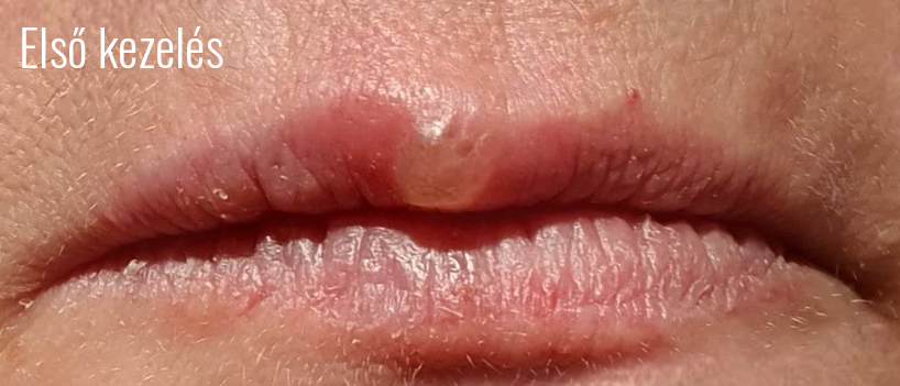 Herpes2.jpg