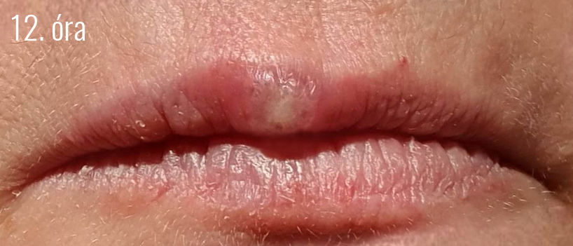 Herpes3.jpg