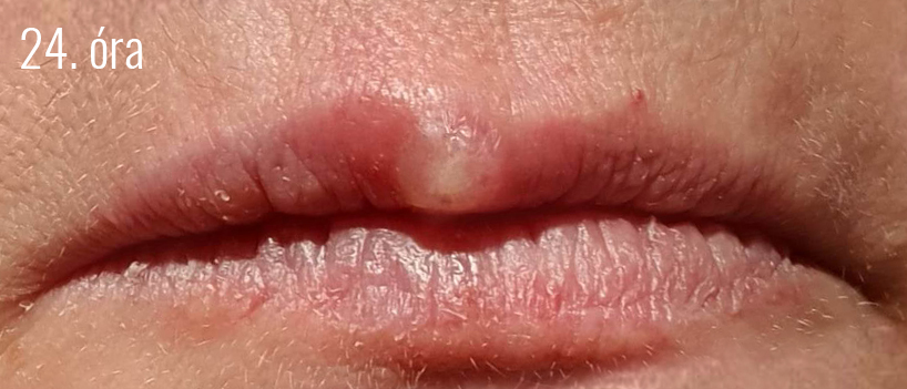 Herpes4.jpg