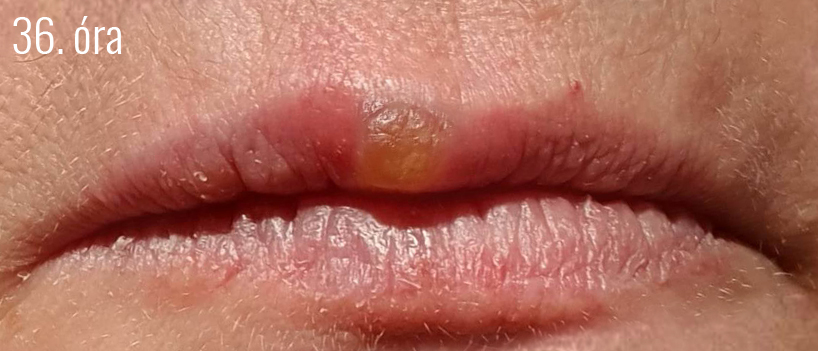 Herpes5.jpg