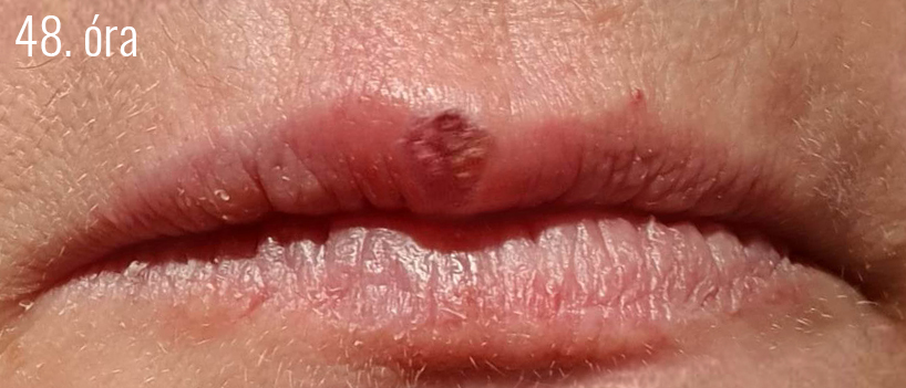 Herpes6.jpg