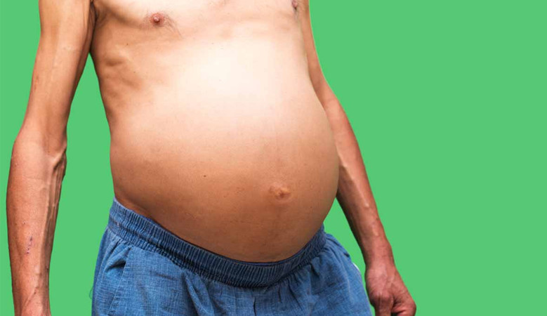 Ascites – a súlyos májbetegség tünete