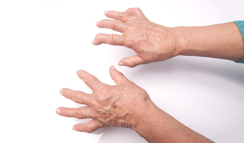 Rheumatoid arthritis, az egyik legsúlyosabb mozgásszervi betegség