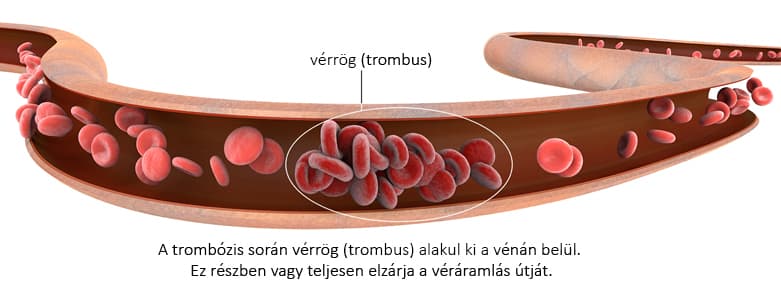 trombus-azaz-verrog-kialakulas-folyamata.jpg
