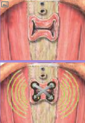 Perisphera-H-sides.png