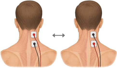 Elektróda polaritás az elektroterápiában – mikor számít, mikor nem?